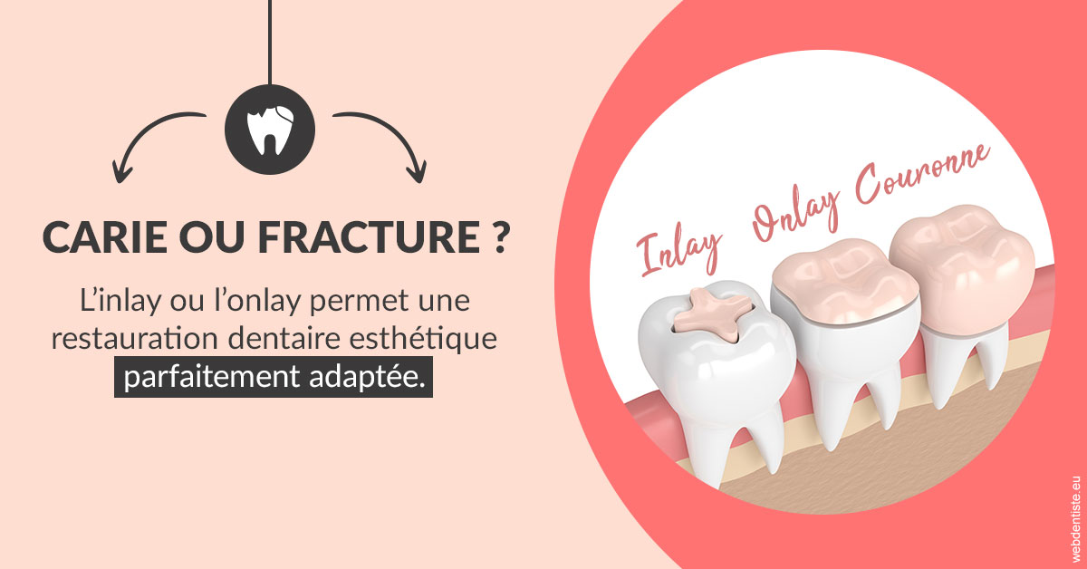 https://selarl-mardam.chirurgiens-dentistes.fr/T2 2023 - Carie ou fracture 2