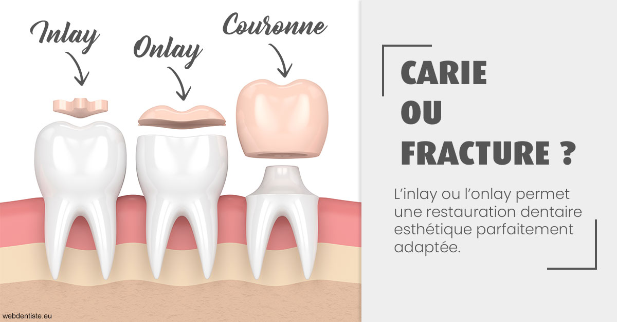 https://selarl-mardam.chirurgiens-dentistes.fr/T2 2023 - Carie ou fracture 1