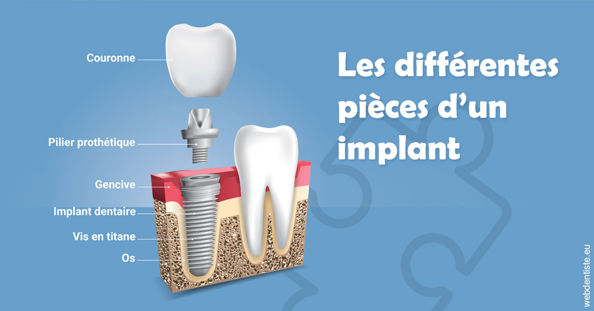 https://selarl-mardam.chirurgiens-dentistes.fr/Les différentes pièces d’un implant 1